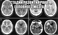 стадии развития рака головного мозга 