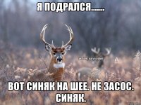 Я подрался....... Вот синяк на шее. Не засос. Синяк.